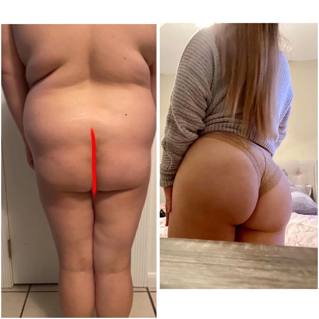 SoBeBL patient before & after