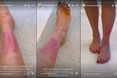 Kim Kardashian Revealed Photos of Her Latest Psoriasis FlareUp Following Tanning Bed Backlash