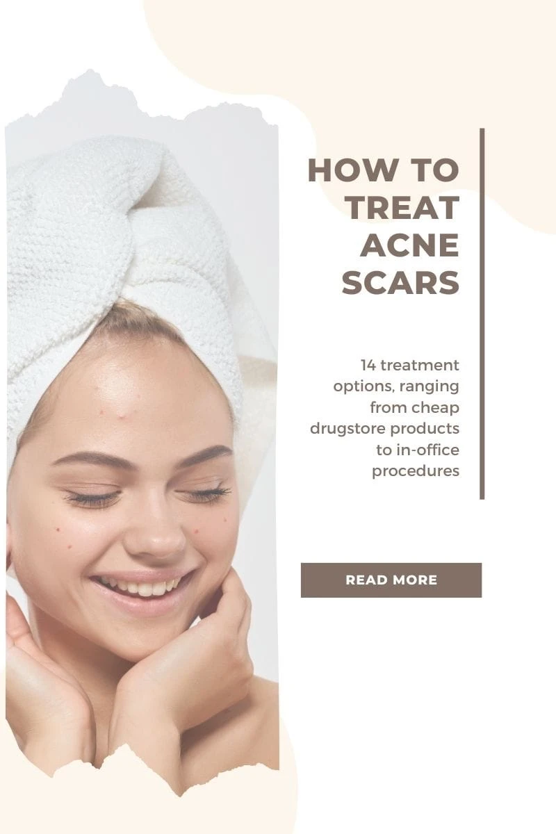 How to treat acne scars.