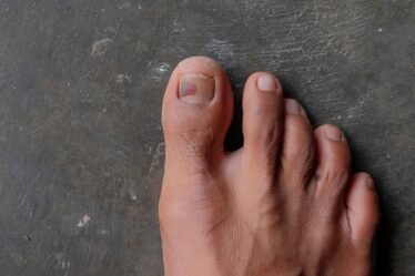 Bruised toenail