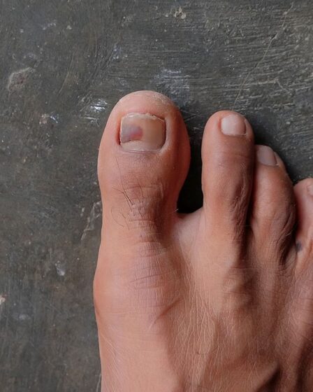 Bruised toenail